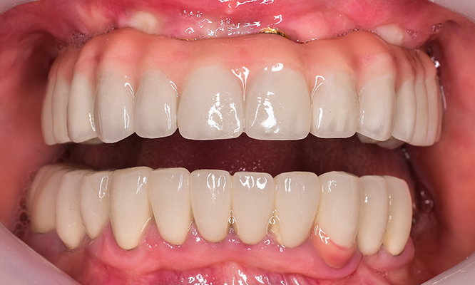 Implant results Mac Dental Macclesfield