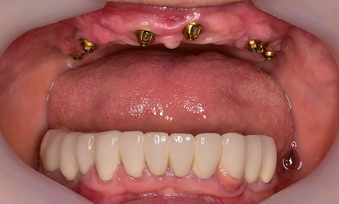 Before implant supported dentures at Mac Dental