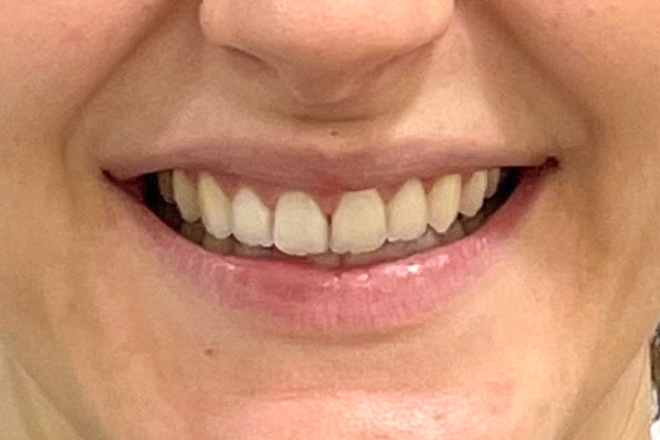 After invisalign teeth straightening at Mac Dental