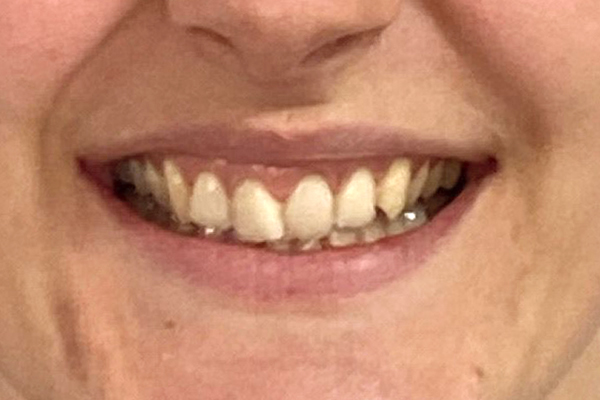 Before invisalign teeth straightening at Mac Dental