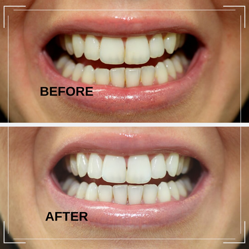 Teeth Whitening before and after example 2