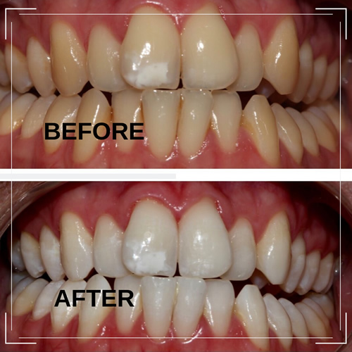 Teeth Whitening before and after example 3