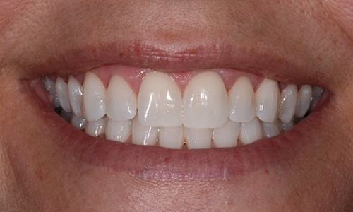 Teeth Whitening example after treatment