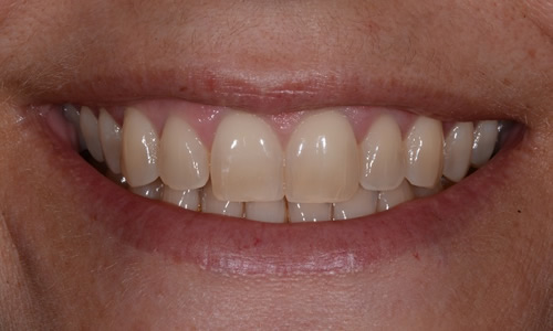 Teeth Whitening example before treatment