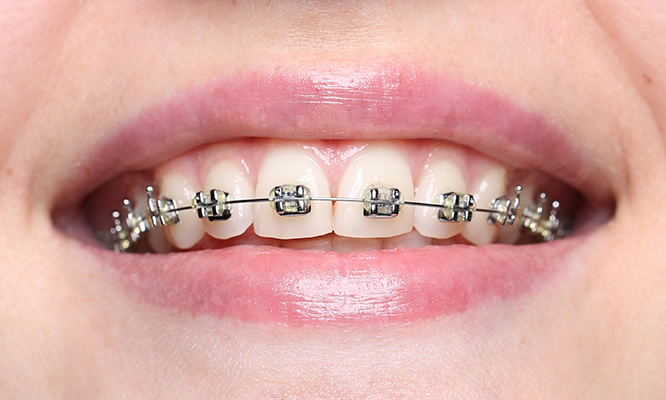 Examples of fixed braces