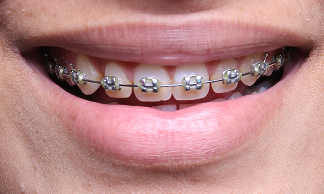 Examples of fixed braces