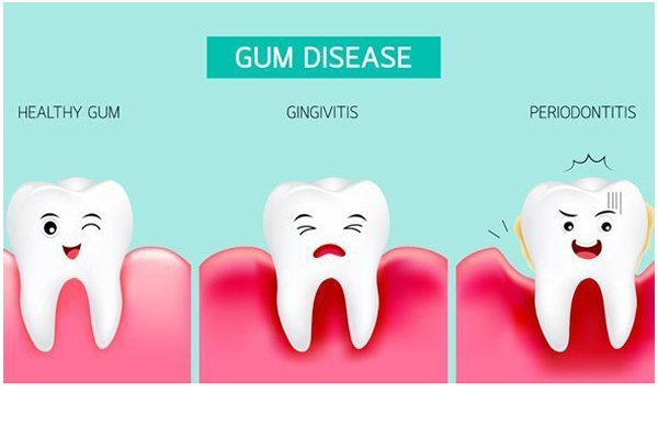 Gum Health